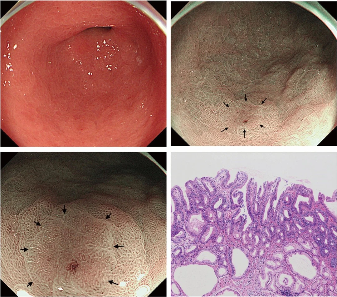 Narrow Imagegery Narrow-band Imaging at Low Magnification Can Detect Lesions Overlooked ...